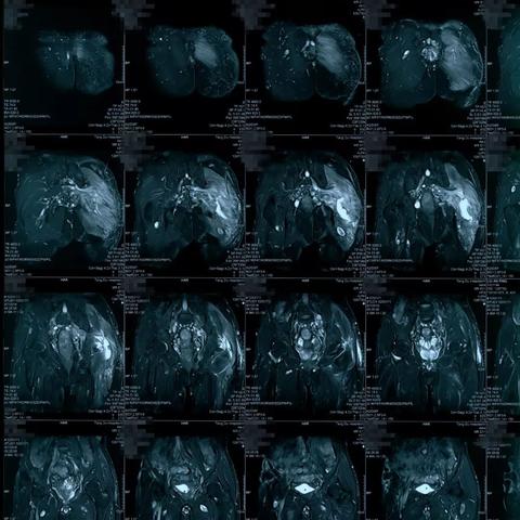 神经纤维瘤最新进展综述报告